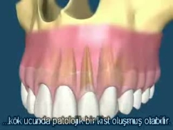 Apikal Rezeksiyon